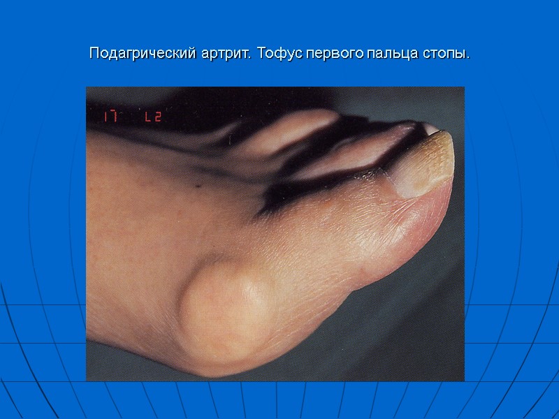 Подагрический артрит. Тофус первого пальца стопы.